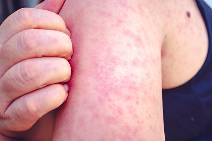 Woman with measles scratching arm