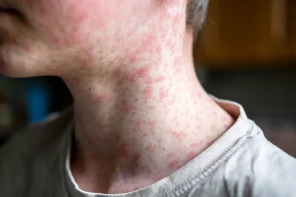 measles-viral-disease-human-skin-132221546